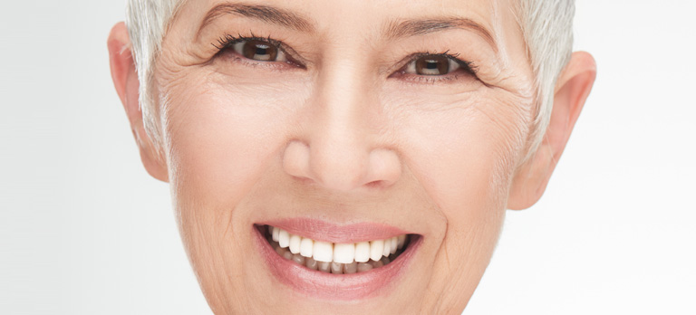 veneers
